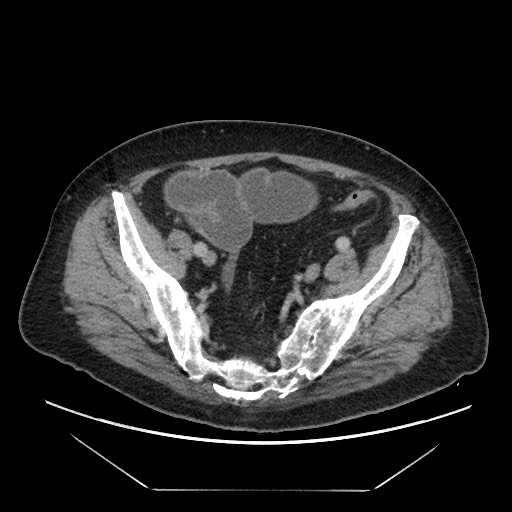 Cecal adenocarcinoma (Radiopaedia 64871-73817 A 77).jpg