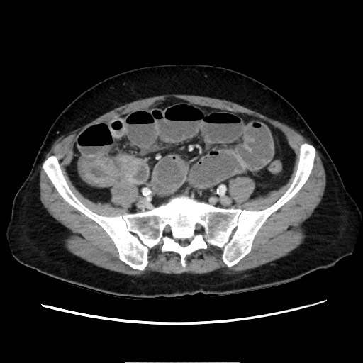 Cecal adenocarcinoma (Radiopaedia 75909-87331 A 65).jpg