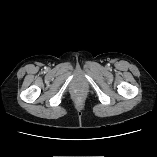 Cecal adenocarcinoma (Radiopaedia 75909-87331 A 92).jpg