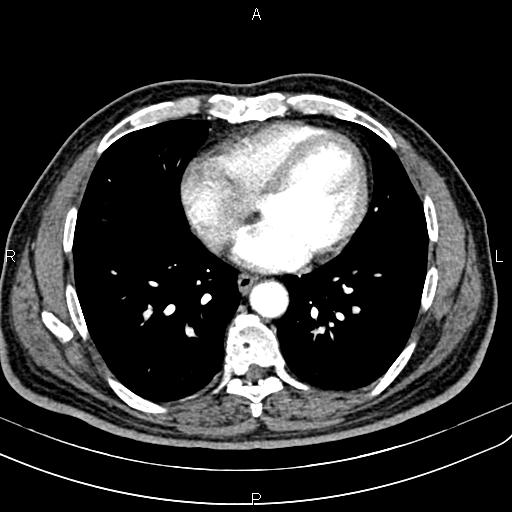 Cecal cancer with appendiceal mucocele (Radiopaedia 91080-108651 A 44).jpg