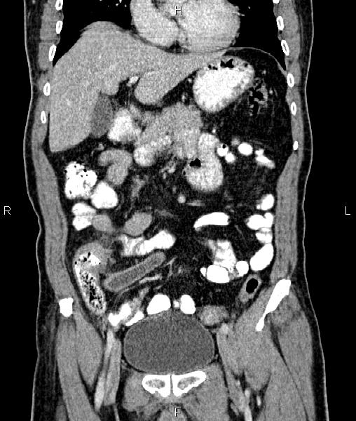Cecal cancer with appendiceal mucocele (Radiopaedia 91080-108651 D 27).jpg