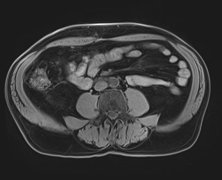 Cecal mass causing appendicitis (Radiopaedia 59207-66532 Axial T1 80).jpg
