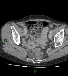 Cecal volvulus (Radiopaedia 86741-102900 A 113).jpg