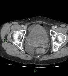 Cecal volvulus (Radiopaedia 86741-102900 A 126).jpg