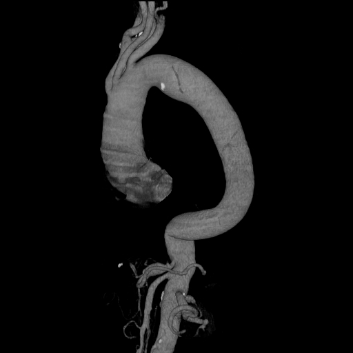File:Celiac artery aneurysm (Radiopaedia 21574-21525 C 5).JPEG