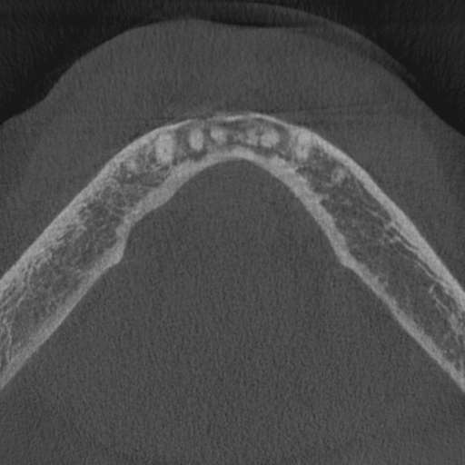 Cemento-osseous dysplasia (Radiopaedia 48251-53126 Axial non-contrast 19).jpg