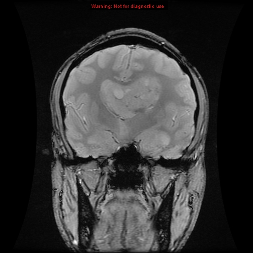 File:Central neurocytoma (Radiopaedia 13188-13206 G 10).jpg