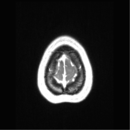 File:Central neurocytoma (Radiopaedia 37664-39557 Axial T1 C+ 74).png