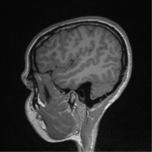 Central neurocytoma (Radiopaedia 37664-39557 Sagittal T1 77).png