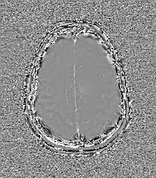 Central neurocytoma (Radiopaedia 84497-99872 Axial 56).jpg