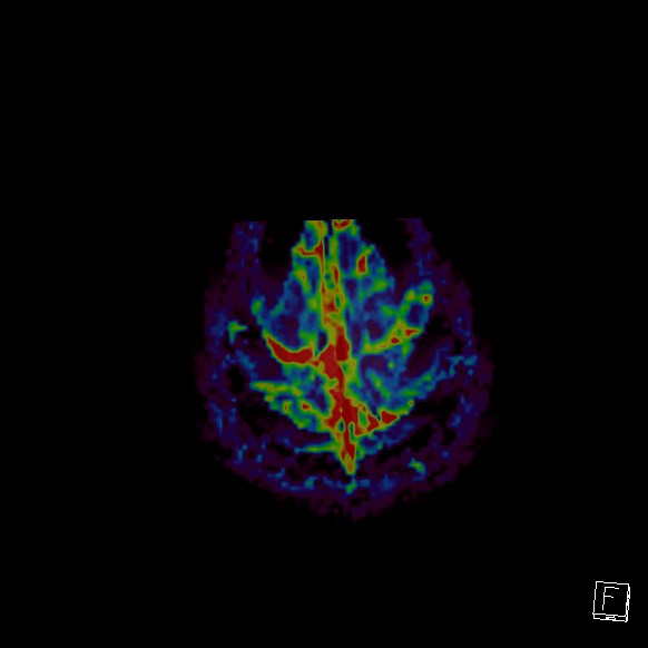 Central neurocytoma (Radiopaedia 84497-99872 Axial Perfusion 18).jpg