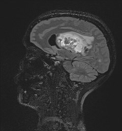 Central neurocytoma (Radiopaedia 84497-99872 Sagittal Flair + Gd 66).jpg
