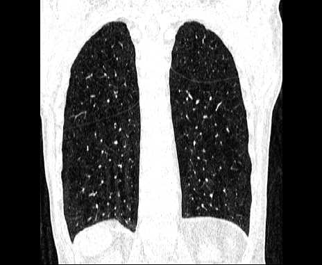 Centrilobular pulmonary emphysema (Radiopaedia 62468-70718 Coronal lung window 57).jpg