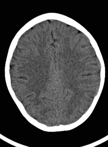 Cerebellar abscess (Radiopaedia 73727-84527 Axial non-contrast 47).jpg