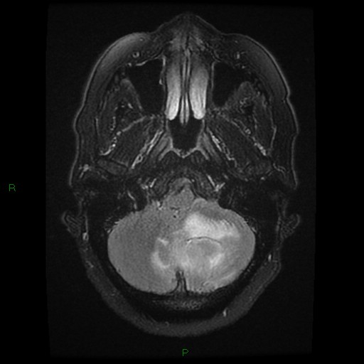 File:Cerebellar abscess (Radiopaedia 78135-90678 Axial FLAIR 7).jpg