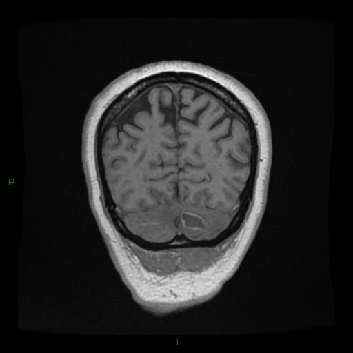 Cerebellar abscess (Radiopaedia 78135-90678 Coronal T1 C+ 140).jpg