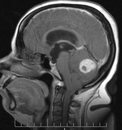 File:Cerebellar hemangioblastoma (Radiopaedia 10779-11234 Sagittal T1 C+ 1).JPG