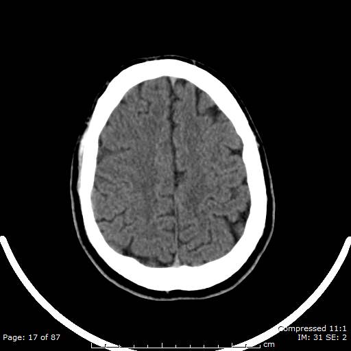 Cerebellar hemangioblastoma (Radiopaedia 52360-58258 Axial non-contrast 17).jpg