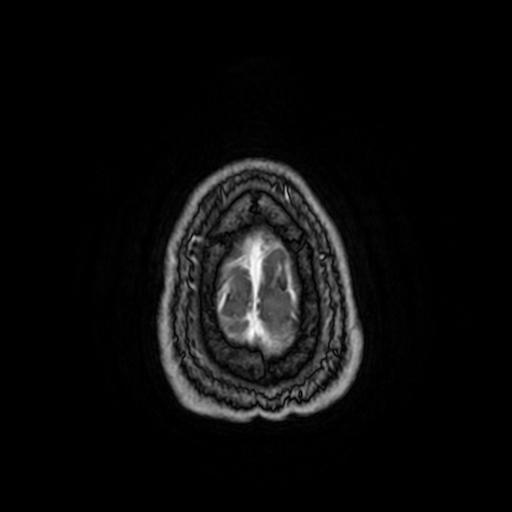 Cerebellar hemangioblastoma (Radiopaedia 88055-104622 Axial T1 C+ 163).jpg