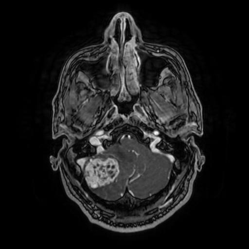 File:Cerebellar hemangioblastoma (Radiopaedia 88055-104622 Axial T1 C+ 41).jpg