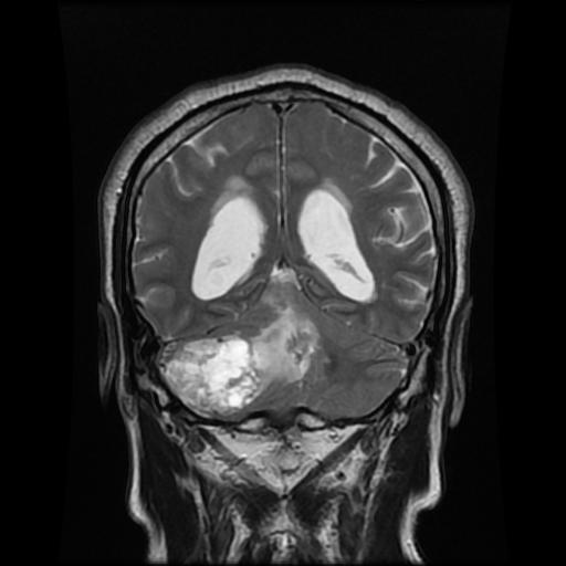 File:Cerebellar hemangioblastoma (Radiopaedia 88055-104622 Coronal T2 12).jpg