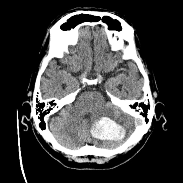 Cerebellar hemorrhage (Radiopaedia 27193-27359 Axial non-contrast 13).jpg