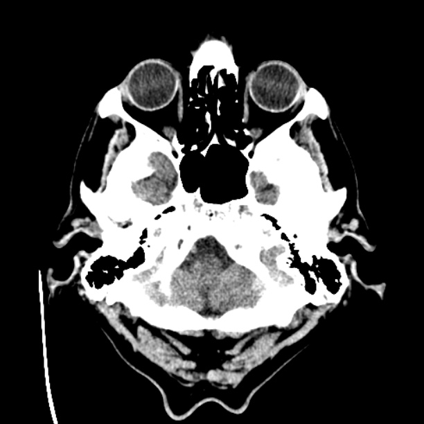 Cerebellar hemorrhage (Radiopaedia 27193-27359 Axial non-contrast 4).jpg