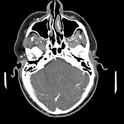 Cerebellar infarct due to vertebral artery dissection with posterior fossa decompression (Radiopaedia 82779-97029 C 17).png