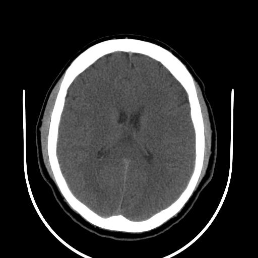 File:Cerebellar infarction (Radiopaedia 16625-16327 Axial non-contrast 23).jpg
