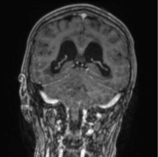 Cerebellar metastasis from lung adenocarcinoma (Radiopaedia 86690-102829 Coronal T1 C+ 41).png
