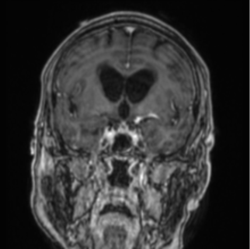 Cerebellar metastasis from lung adenocarcinoma (Radiopaedia 86690-102829 Coronal T1 C+ 60).png
