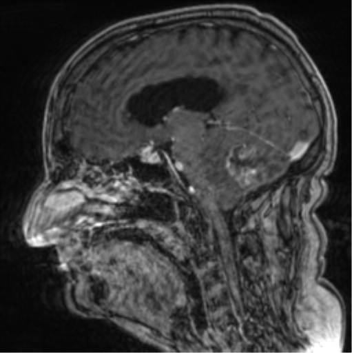 Cerebellar metastasis from lung adenocarcinoma (Radiopaedia 86690-102829 Sagittal T1 C+ 45).png