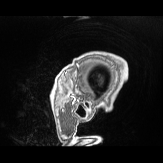 Cerebellar metastasis of pulmonary adenocarcinoma, cavernous venous malformation, and developmental venous anomaly (Radiopaedia 85827-101661 Sagittal T1 C+ 87).jpg