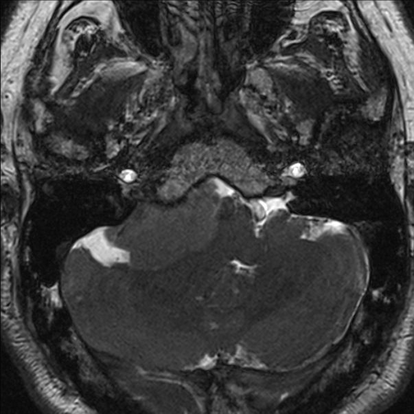 Cerebellopontine angle meningioma (Radiopaedia 24459-24764 I 16).jpg