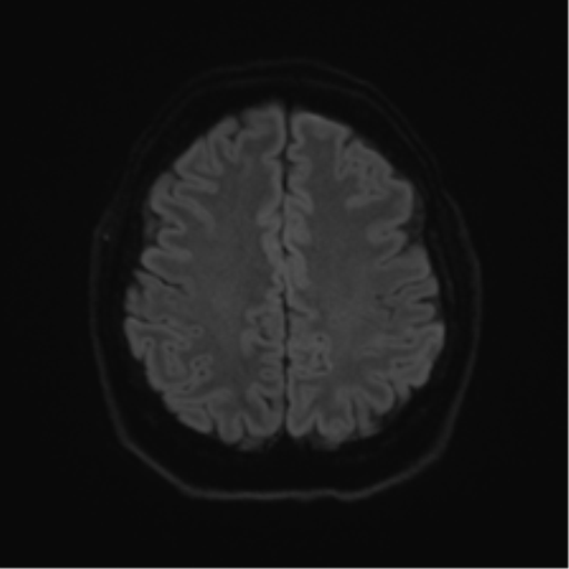 Cerebellopontine angle meningioma (Radiopaedia 48434-53348 Axial DWI 65).png