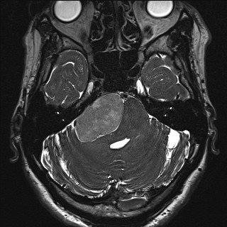 Cerebellopontine angle meningioma (Radiopaedia 72983-83680 Axial FIESTA 36).jpg
