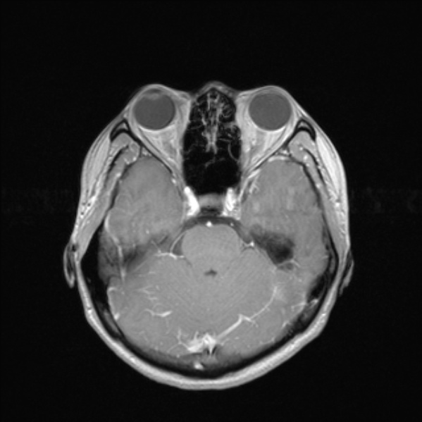 Cerebral abscess (Radiopaedia 24212-24478 Axial T1 C+ 23).jpg