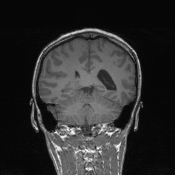Cerebral abscess (Radiopaedia 24212-24478 Coronal T1 139).jpg