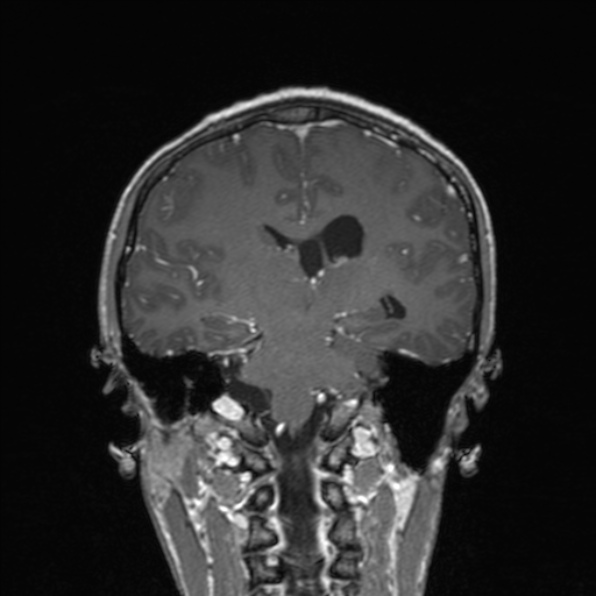 Cerebral abscess (Radiopaedia 24212-24478 Coronal T1 C+ 126).jpg