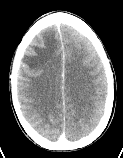 Cerebral abscess (Radiopaedia 60342-68008 Axial C+ delayed 35).png