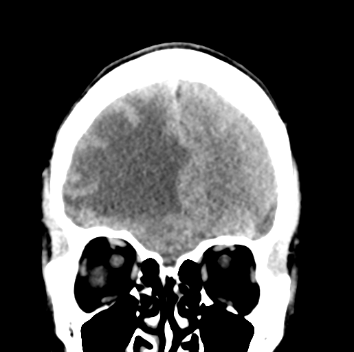 Cerebral abscess (Radiopaedia 60342-68008 Coronal non-contrast 14).png