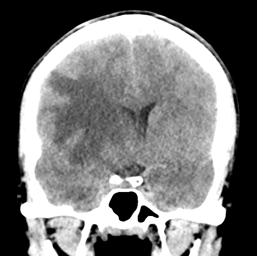 Cerebral abscess (Radiopaedia 60342-68008 Coronal non-contrast 27).png