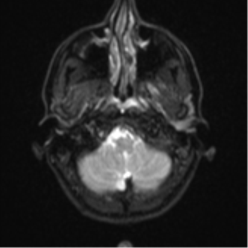 File:Cerebral abscess (Radiopaedia 60342-68009 Axial DWI 4).png