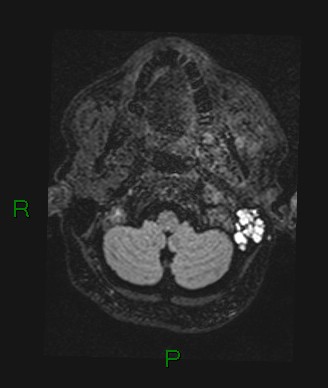 Cerebral abscess and subdural empyema (Radiopaedia 84436-99779 Axial FLAIR 76).jpg