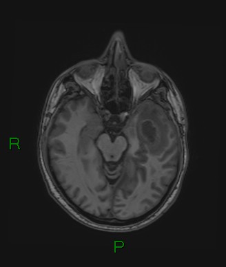 Cerebral abscess and subdural empyema (Radiopaedia 84436-99779 Axial T1 53).jpg