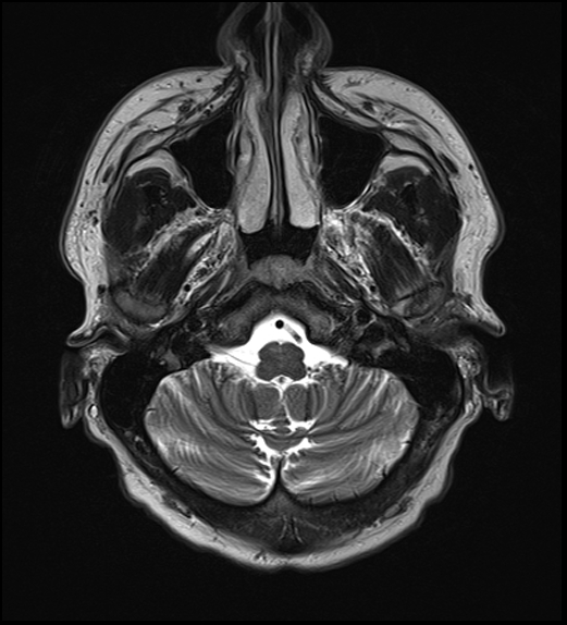 File:Cerebral abscess with ventriculitis (Radiopaedia 78965-91878 Axial T2 8).jpg