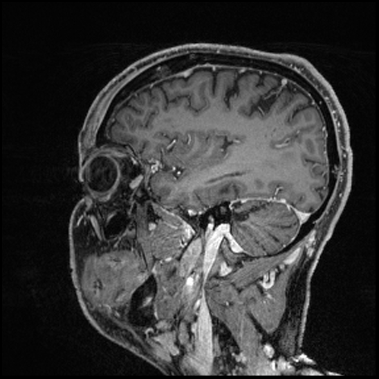 Cerebral abscess with ventriculitis (Radiopaedia 78965-91878 Sagittal T1 C+ 53).jpg