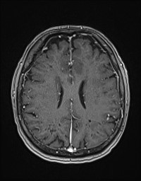 Cerebral amyloid angiopathy-related inflammation (Radiopaedia 58270-65377 Axial T1 C+ fat sat 96).jpg