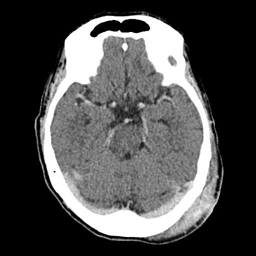 Cerebral amyloid angiopathy-related inflammation (Radiopaedia 74836-85848 Axial non-contrast 24).jpg
