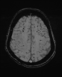 Cerebral amyloid angiopathy-related inflammation (Radiopaedia 74836-85849 Axial SWI 54).jpg